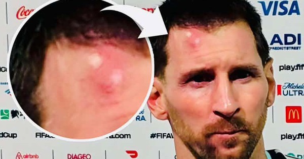 Messi sưng vêu trán sau trận thắng Cabo Verde: Chấn thương nhỏ, tinh thần lớn - hình ảnh - appok9.vip